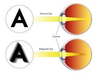 Vision defects and corrective lenses | PPT