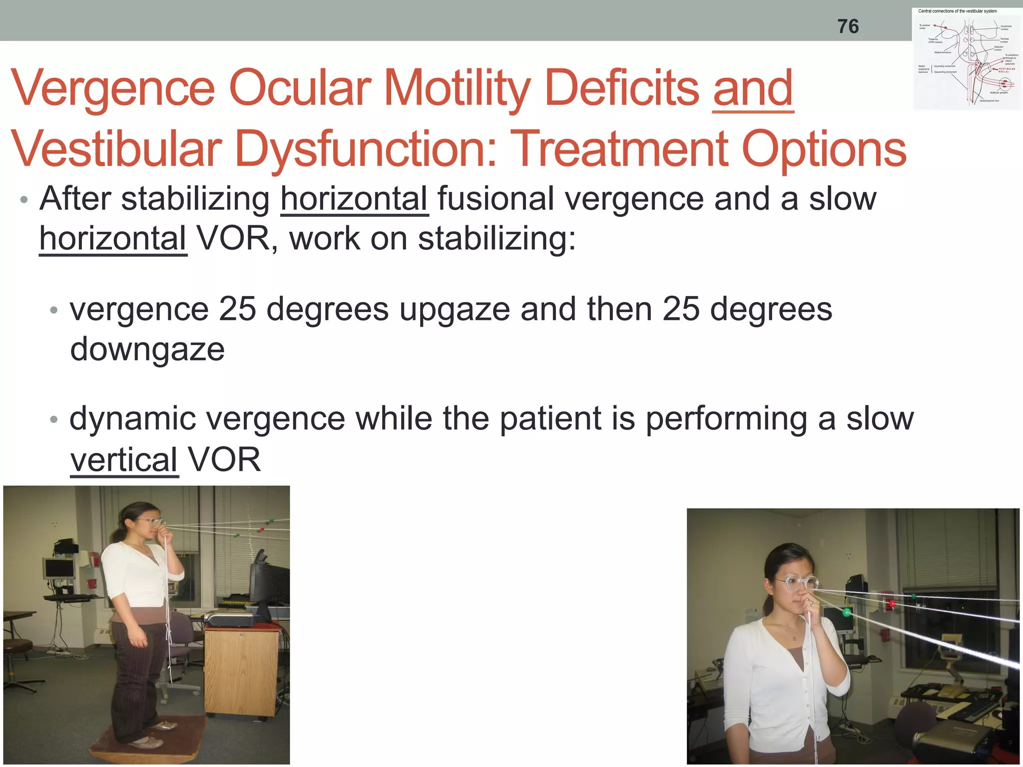 Vergence Ocular Motility Deficits and
Vestibular Dysfunction: Treatment Options
•  After stabilizing horizontal fusional vergence and a slow
horizontal VOR, work on stabilizing:
•  vergence 25 degrees upgaze and then 25 degrees
downgaze
•  dynamic vergence while the patient is performing a slow
vertical VOR
76
 