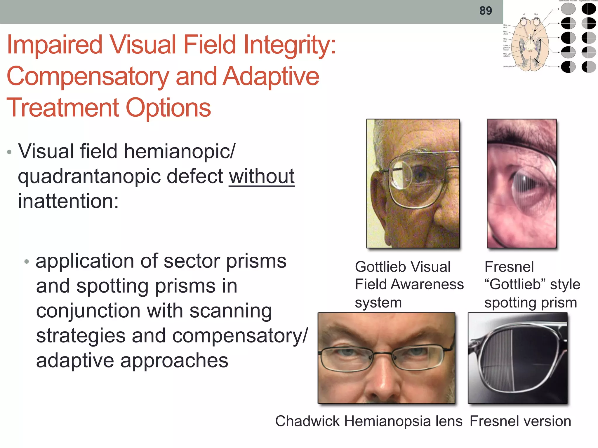 Impaired Visual Field Integrity:
Compensatory and Adaptive
Treatment Options
•  Visual field hemianopic/
quadrantanopic defect without
inattention:
•  application of sector prisms
and spotting prisms in
conjunction with scanning
strategies and compensatory/
adaptive approaches
89
Gottlieb Visual
Field Awareness
system
Fresnel
“Gottlieb” style
spotting prism
Chadwick Hemianopsia lens Fresnel version
 