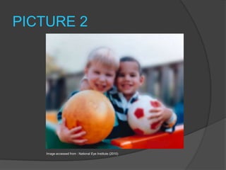 PICTURE 2Image accessed from : National Eye Institute (2010)