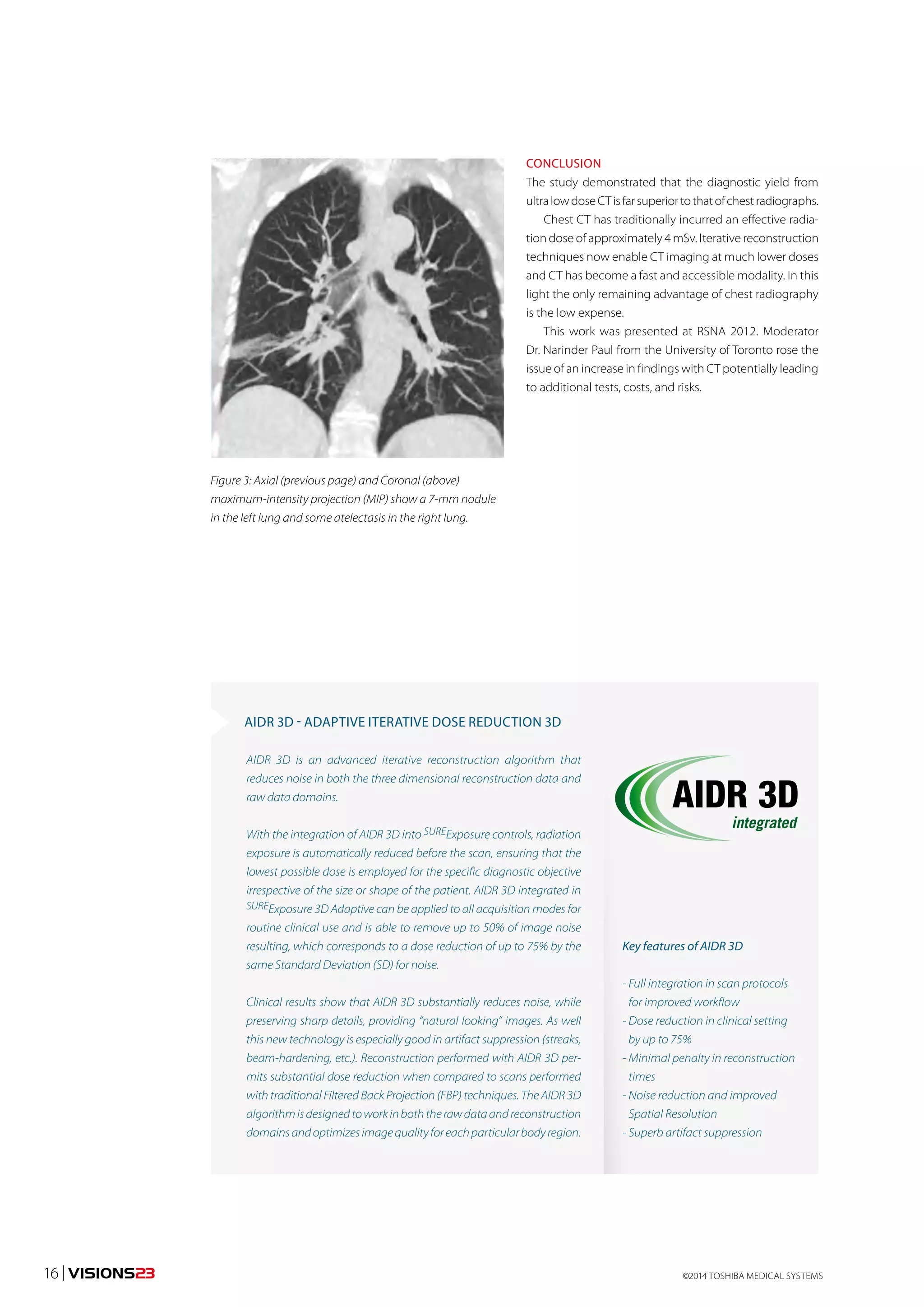 CONCLUSION 
The study demonstrated that the diagnostic yield from 
ultra low dose CT is far superior to that of chest radiographs. 
Chest CT has traditionally incurred an effective radia-tion 
dose of approximately 4 mSv. Iterative reconstruction 
techniques now enable CT imaging at much lower doses 
and CT has become a fast and accessible modality. In this 
light the only remaining advantage of chest radiography 
is the low expense. 
This work was presented at RSNA 2012. Moderator 
Dr. Narinder Paul from the University of Toronto rose the 
issue of an increase in findings with CT potentially leading 
to additional tests, costs, and risks. 
Figure 3: Axial (previous page) and Coronal (above) 
maximum-intensity projection (MIP) show a 7-mm nodule 
in the left lung and some atelectasis in the right lung. 
AIDR 3D - ADAPTIVE ITERATIVE DOSE REDUCTION 3D 
AIDR 3D is an advanced iterative reconstruction algorithm that 
reduces noise in both the three dimensional reconstruction data and 
raw data domains. 
With the integration of AIDR 3D into SUREExposure controls, radiation 
exposure is automatically reduced before the scan, ensuring that the 
lowest possible dose is employed for the specific diagnostic objective 
irrespective of the size or shape of the patient. AIDR 3D integrated in 
SUREExposure 3D Adaptive can be applied to all acquisition modes for 
routine clinical use and is able to remove up to 50% of image noise 
resulting, which corresponds to a dose reduction of up to 75% by the 
same Standard Deviation (SD) for noise. 
Clinical results show that AIDR 3D substantially reduces noise, while 
preserving sharp details, providing “natural looking” images. As well 
this new technology is especially good in artifact suppression (streaks, 
beam-hardening, etc.). Reconstruction performed with AIDR 3D per-mits 
substantial dose reduction when compared to scans performed 
with traditional Filtered Back Projection (FBP) techniques. The AIDR 3D 
algorithm is designed to work in both the raw data and reconstruction 
domains and optimizes image quality for each particular body region. 
Key features of AIDR 3D 
- Full integration in scan protocols 
for improved workflow 
- Dose reduction in clinical setting 
by up to 75% 
- Minimal penalty in reconstruction 
times 
- Noise reduction and improved 
Spatial Resolution 
- Superb artifact suppression 
©2014 16 | VISIONS23 TOSHIBA MEDICAL SYSTEMS 
 