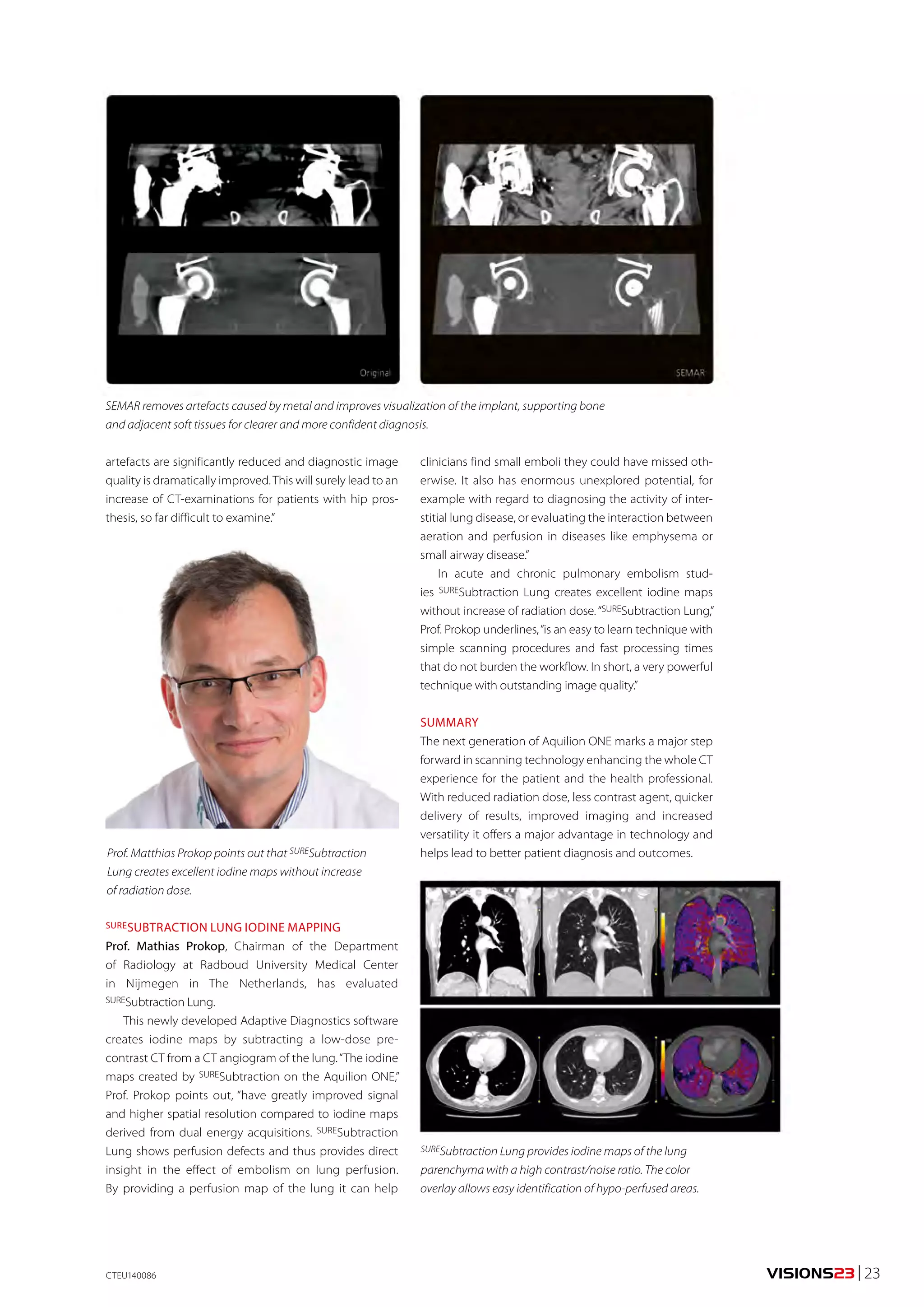 VISIONS23 | 23 
SEMAR removes artefacts caused by metal and improves visualization of the implant, supporting bone 
and adjacent soft tissues for clearer and more confident diagnosis. 
artefacts are significantly reduced and diagnostic image 
quality is dramatically improved. This will surely lead to an 
increase of CT-examinations for patients with hip pros-thesis, 
so far difficult to examine.” 
SURESUBTRACTION LUNG IODINE MAPPING 
Prof. Mathias Prokop, Chairman of the Department 
of Radiology at Radboud University Medical Center 
in Nijmegen in The Netherlands, has evaluated 
SURESubtraction Lung. 
This newly developed Adaptive Diagnostics software 
creates iodine maps by subtracting a low-dose pre-contrast 
CT from a CT angiogram of the lung. “The iodine 
maps created by SURESubtraction on the Aquilion ONE,” 
Prof. Prokop points out, “have greatly improved signal 
and higher spatial resolution compared to iodine maps 
derived from dual energy acquisitions. SURESubtraction 
Lung shows perfusion defects and thus provides direct 
insight in the effect of embolism on lung perfusion. 
By providing a perfusion map of the lung it can help 
SURESubtraction Lung provides iodine maps of the lung 
parenchyma with a high contrast/noise ratio. The color 
overlay allows easy identification of hypo-perfused areas. 
Prof. Matthias Prokop points out that SURESubtraction 
Lung creates excellent iodine maps without increase 
of radiation dose. 
clinicians find small emboli they could have missed oth-erwise. 
It also has enormous unexplored potential, for 
example with regard to diagnosing the activity of inter-stitial 
lung disease, or evaluating the interaction between 
aeration and perfusion in diseases like emphysema or 
small airway disease.” 
In acute and chronic pulmonary embolism stud-ies 
SURESubtraction Lung creates excellent iodine maps 
without increase of radiation dose. “SURESubtraction Lung,” 
Prof. Prokop underlines, “is an easy to learn technique with 
simple scanning procedures and fast processing times 
that do not burden the workflow. In short, a very powerful 
technique with outstanding image quality.” 
SUMMARY 
The next generation of Aquilion ONE marks a major step 
forward in scanning technology enhancing the whole CT 
experience for the patient and the health professional. 
With reduced radiation dose, less contrast agent, quicker 
delivery of results, improved imaging and increased 
versatility it offers a major advantage in technology and 
helps lead to better patient diagnosis and outcomes. 
CTEU140086 
 