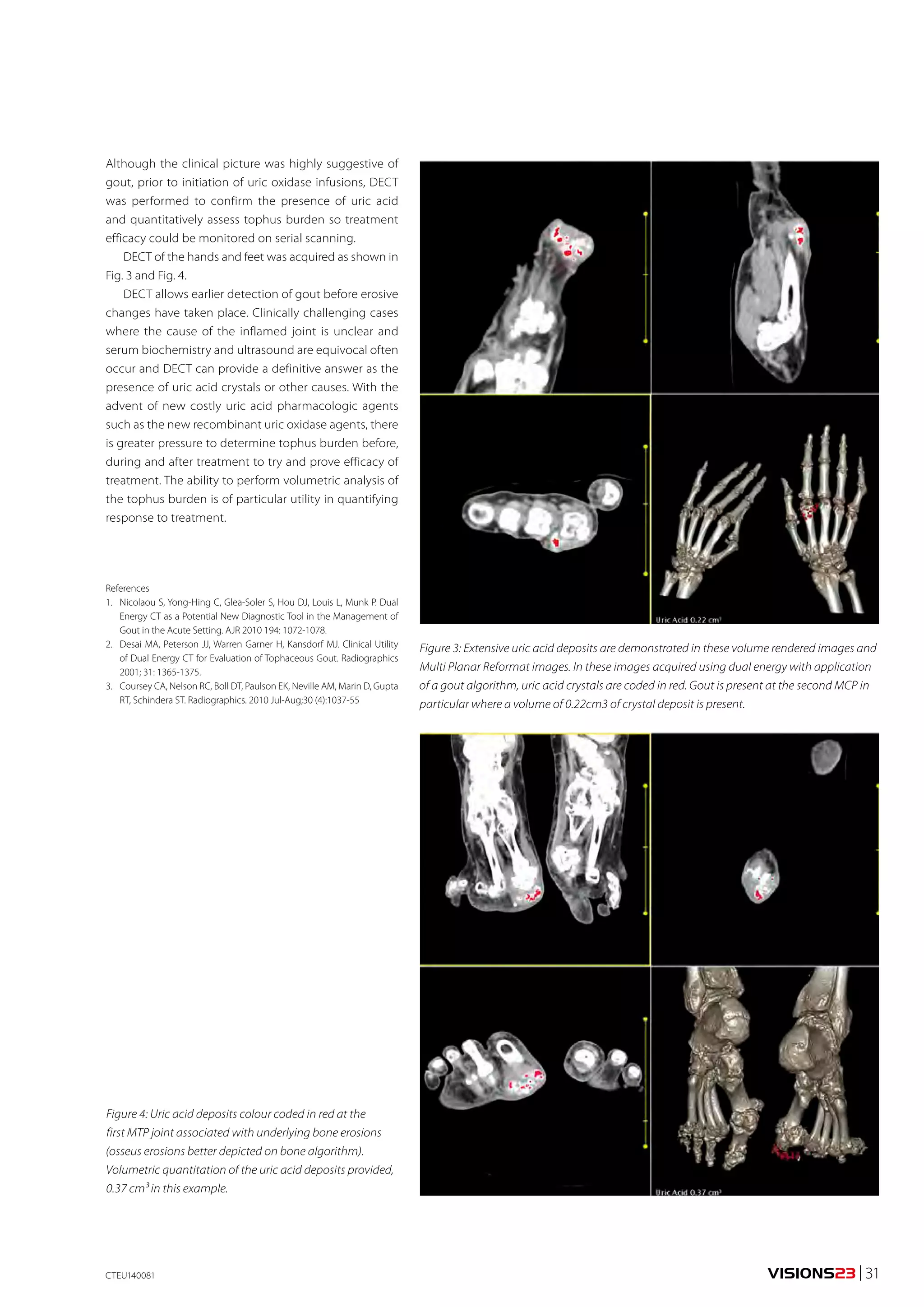VISIONS23 | 31 
Although the clinical picture was highly suggestive of 
gout, prior to initiation of uric oxidase infusions, DECT 
was performed to confirm the presence of uric acid 
and quantitatively assess tophus burden so treatment 
efficacy could be monitored on serial scanning. 
DECT of the hands and feet was acquired as shown in 
Fig. 3 and Fig. 4. 
DECT allows earlier detection of gout before erosive 
changes have taken place. Clinically challenging cases 
where the cause of the inflamed joint is unclear and 
serum biochemistry and ultrasound are equivocal often 
occur and DECT can provide a definitive answer as the 
presence of uric acid crystals or other causes. With the 
advent of new costly uric acid pharmacologic agents 
such as the new recombinant uric oxidase agents, there 
is greater pressure to determine tophus burden before, 
during and after treatment to try and prove efficacy of 
treatment. The ability to perform volumetric analysis of 
the tophus burden is of particular utility in quantifying 
response to treatment. 
References 
1. Nicolaou S, Yong-Hing C, Glea-Soler S, Hou DJ, Louis L, Munk P. Dual 
Energy CT as a Potential New Diagnostic Tool in the Management of 
Gout in the Acute Setting. AJR 2010 194: 1072-1078. 
2. Desai MA, Peterson JJ, Warren Garner H, Kansdorf MJ. Clinical Utility 
of Dual Energy CT for Evaluation of Tophaceous Gout. Radiographics 
2001; 31: 1365-1375. 
3. Coursey CA, Nelson RC, Boll DT, Paulson EK, Neville AM, Marin D, Gupta 
RT, Schindera ST. Radiographics. 2010 Jul-Aug;30 (4):1037-55 
Figure 3: Extensive uric acid deposits are demonstrated in these volume rendered images and 
Multi Planar Reformat images. In these images acquired using dual energy with application 
of a gout algorithm, uric acid crystals are coded in red. Gout is present at the second MCP in 
particular where a volume of 0.22cm3 of crystal deposit is present. 
Figure 4: Uric acid deposits colour coded in red at the 
first MTP joint associated with underlying bone erosions 
(osseus erosions better depicted on bone algorithm). 
Volumetric quantitation of the uric acid deposits provided, 
0.37 cm³ in this example. 
CTEU140081 
 