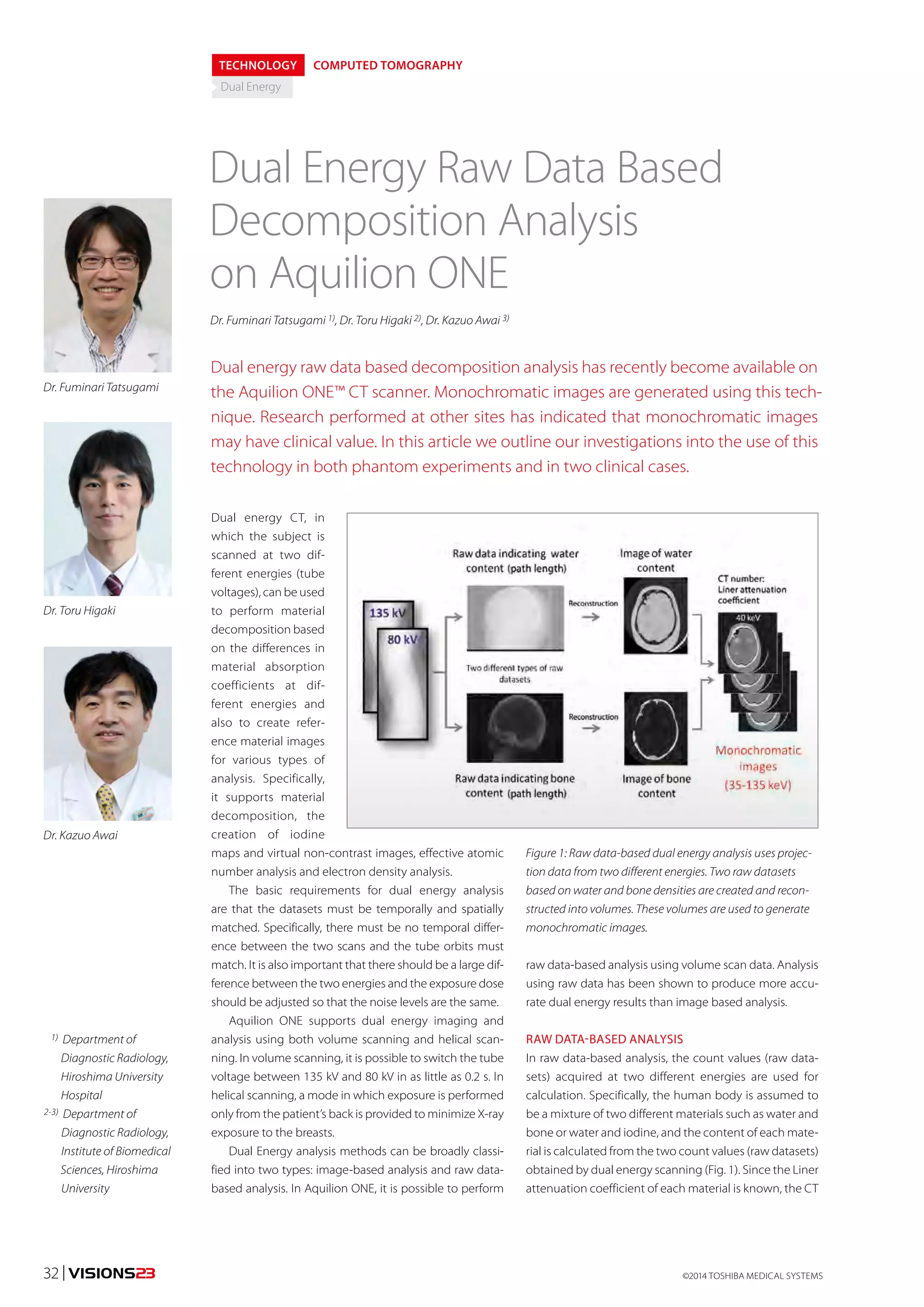 TECHNOLOGY COMPUTED TOMOGRAPHY 
Dual Energy 
Dual Energy Raw Data Based 
Decomposition Analysis 
on Aquilion ONE 
Dr. Fuminari Tatsugami 1), Dr. Toru Higaki 2), Dr. Kazuo Awai 3) 
Dual energy raw data based decomposition analysis has recently become available on 
the Aquilion ONE™ CT scanner. Monochromatic images are generated using this tech-nique. 
Research performed at other sites has indicated that monochromatic images 
may have clinical value. In this article we outline our investigations into the use of this 
technology in both phantom experiments and in two clinical cases. 
Dual energy CT, in 
which the subject is 
scanned at two dif-ferent 
energies (tube 
voltages), can be used 
to perform material 
decomposition based 
on the differences in 
material absorption 
coefficients at dif-ferent 
energies and 
also to create refer-ence 
material images 
for various types of 
analysis. Specifically, 
it supports material 
decomposition, the 
creation of iodine 
maps and virtual non-contrast images, effective atomic 
number analysis and electron density analysis. 
The basic requirements for dual energy analysis 
are that the datasets must be temporally and spatially 
matched. Specifically, there must be no temporal differ-ence 
between the two scans and the tube orbits must 
match. It is also important that there should be a large dif-ference 
between the two energies and the exposure dose 
should be adjusted so that the noise levels are the same. 
Aquilion ONE supports dual energy imaging and 
analysis using both volume scanning and helical scan-ning. 
In volume scanning, it is possible to switch the tube 
voltage between 135 kV and 80 kV in as little as 0.2 s. In 
helical scanning, a mode in which exposure is performed 
only from the patient’s back is provided to minimize X-ray 
exposure to the breasts. 
Dual Energy analysis methods can be broadly classi-fied 
into two types: image-based analysis and raw data-based 
analysis. In Aquilion ONE, it is possible to perform 
Dr. Fuminari Tatsugami 
Dr. Toru Higaki 
Dr. Kazuo Awai 
1) Department of 
Diagnostic Radiology, 
Hiroshima University 
Hospital 
2-3) Department of 
Diagnostic Radiology, 
Institute of Biomedical 
Sciences, Hiroshima 
University 
Figure 1: Raw data-based dual energy analysis uses projec-tion 
data from two different energies. Two raw datasets 
based on water and bone densities are created and recon-structed 
into volumes. These volumes are used to generate 
monochromatic images. 
raw data-based analysis using volume scan data. Analysis 
using raw data has been shown to produce more accu-rate 
dual energy results than image based analysis. 
RAW DATA-BASED ANALYSIS 
In raw data-based analysis, the count values (raw data-sets) 
acquired at two different energies are used for 
calculation. Specifically, the human body is assumed to 
be a mixture of two different materials such as water and 
bone or water and iodine, and the content of each mate-rial 
is calculated from the two count values (raw datasets) 
obtained by dual energy scanning (Fig. 1). Since the Liner 
attenuation coefficient of each material is known, the CT 
©2014 32 | VISIONS23 TOSHIBA MEDICAL SYSTEMS 
 