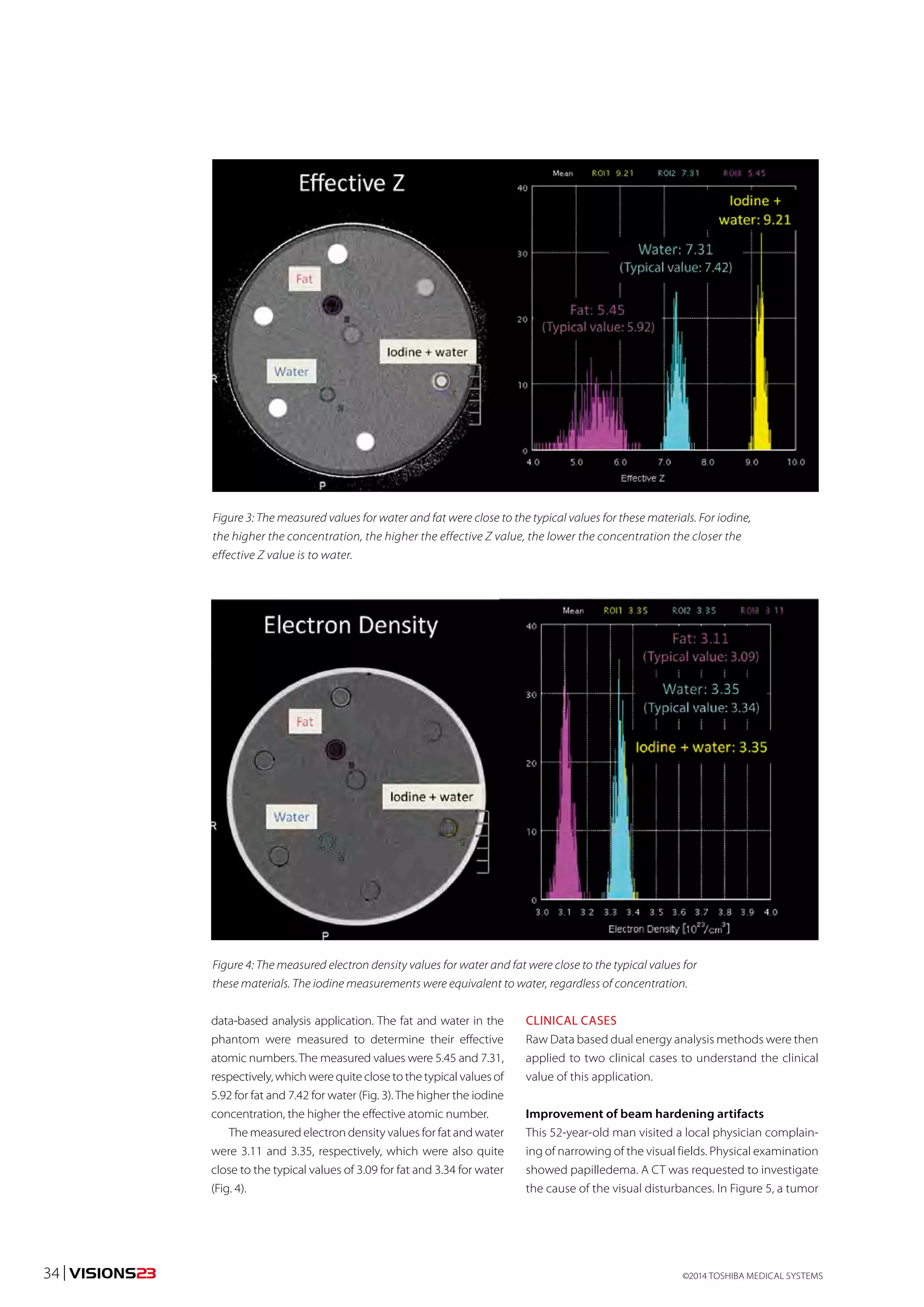 Figure 3: The measured values for water and fat were close to the typical values for these materials. For iodine, 
the higher the concentration, the higher the effective Z value, the lower the concentration the closer the 
effective Z value is to water. 
Figure 4: The measured electron density values for water and fat were close to the typical values for 
these materials. The iodine measurements were equivalent to water, regardless of concentration. 
data-based analysis application. The fat and water in the 
phantom were measured to determine their effective 
atomic numbers. The measured values were 5.45 and 7.31, 
respectively, which were quite close to the typical values of 
5.92 for fat and 7.42 for water (Fig. 3). The higher the iodine 
concentration, the higher the effective atomic number. 
The measured electron density values for fat and water 
were 3.11 and 3.35, respectively, which were also quite 
close to the typical values of 3.09 for fat and 3.34 for water 
(Fig. 4). 
CLINICAL CASES 
Raw Data based dual energy analysis methods were then 
applied to two clinical cases to understand the clinical 
value of this application. 
Improvement of beam hardening artifacts 
This 52-year-old man visited a local physician complain-ing 
of narrowing of the visual fields. Physical examination 
showed papilledema. A CT was requested to investigate 
the cause of the visual disturbances. In Figure 5, a tumor 
©2014 34 | VISIONS23 TOSHIBA MEDICAL SYSTEMS 
 