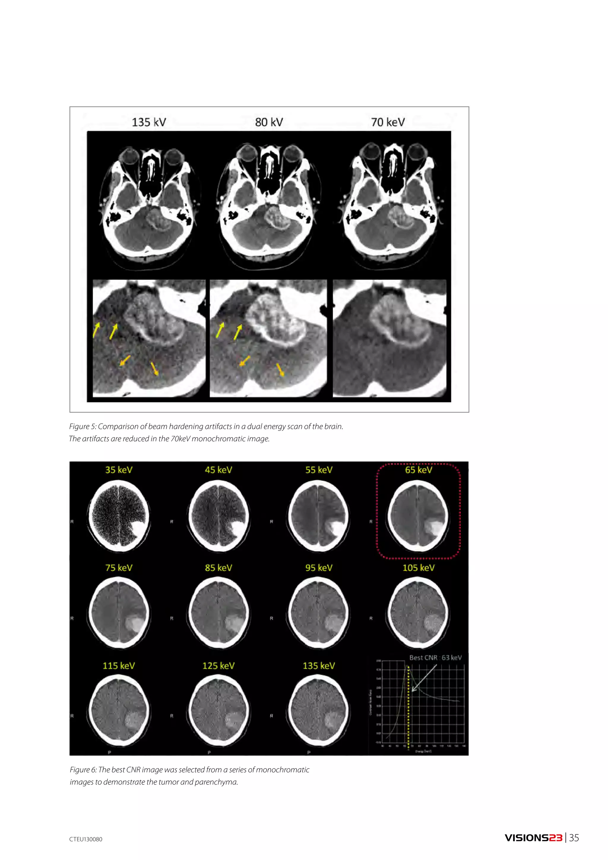VISIONS23 | 35 
Figure 5: Comparison of beam hardening artifacts in a dual energy scan of the brain. 
The artifacts are reduced in the 70keV monochromatic image. 
Figure 6: The best CNR image was selected from a series of monochromatic 
images to demonstrate the tumor and parenchyma. 
CTEU130080 
 