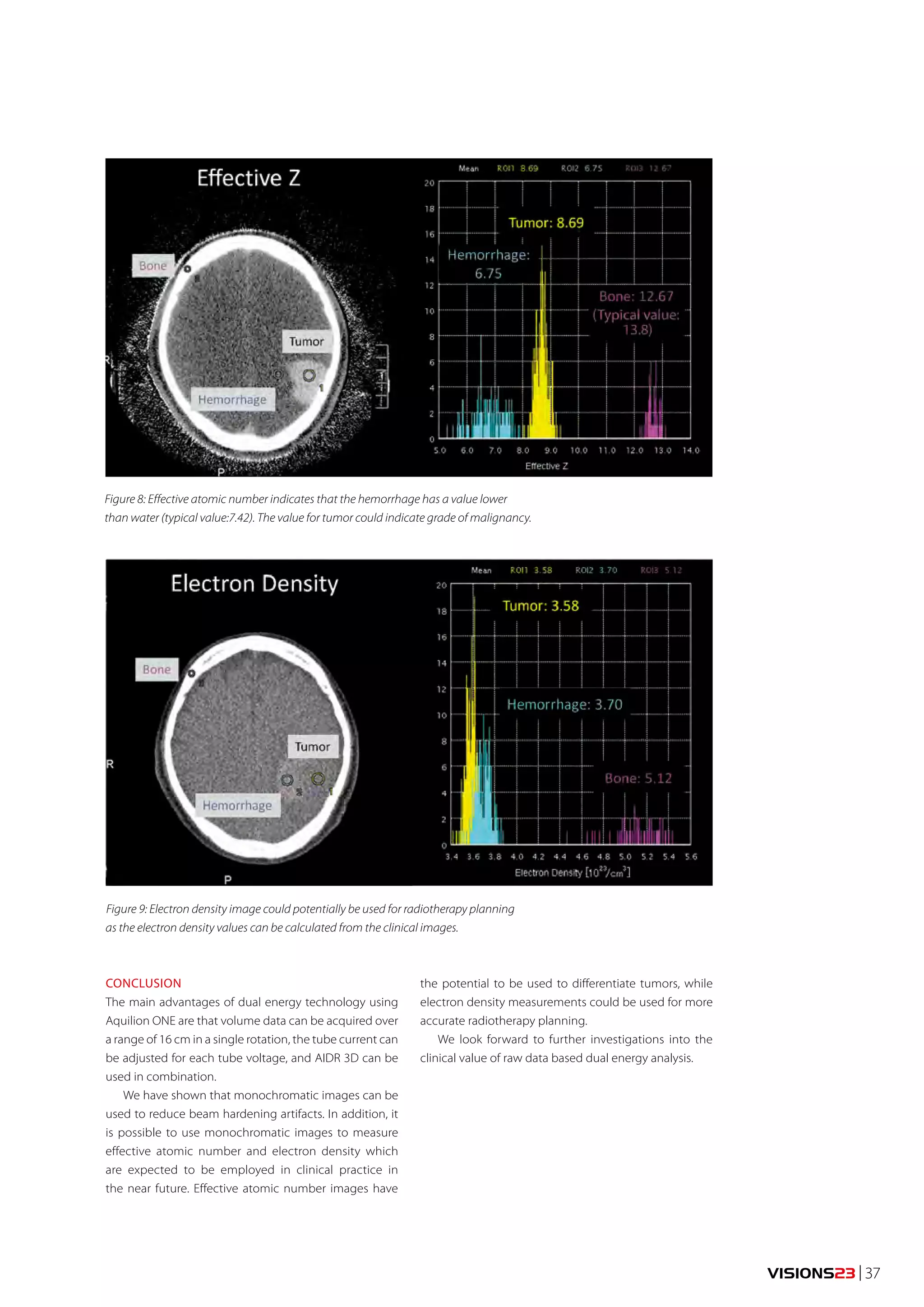 VISIONS23 | 37 
Figure 8: Effective atomic number indicates that the hemorrhage has a value lower 
than water (typical value:7.42). The value for tumor could indicate grade of malignancy. 
Figure 9: Electron density image could potentially be used for radiotherapy planning 
as the electron density values can be calculated from the clinical images. 
CONCLUSION 
The main advantages of dual energy technology using 
Aquilion ONE are that volume data can be acquired over 
a range of 16 cm in a single rotation, the tube current can 
be adjusted for each tube voltage, and AIDR 3D can be 
used in combination. 
We have shown that monochromatic images can be 
used to reduce beam hardening artifacts. In addition, it 
is possible to use monochromatic images to measure 
effective atomic number and electron density which 
are expected to be employed in clinical practice in 
the near future. Effective atomic number images have 
the potential to be used to differentiate tumors, while 
electron density measurements could be used for more 
accurate radiotherapy planning. 
We look forward to further investigations into the 
clinical value of raw data based dual energy analysis. 
 