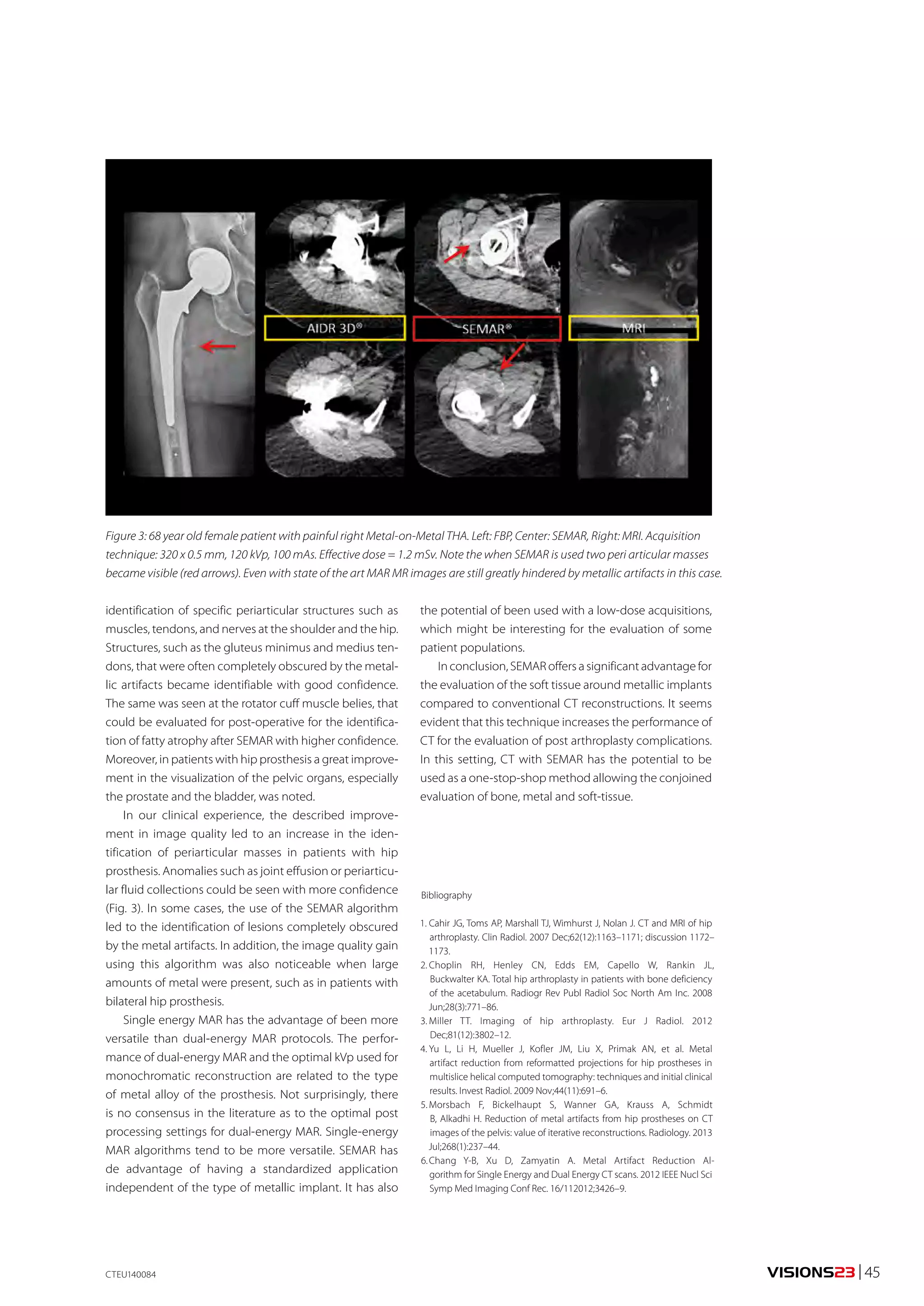 VISIONS23 | 45 
Figure 3: 68 year old female patient with painful right Metal-on-Metal THA. Left: FBP, Center: SEMAR, Right: MRI. Acquisition 
technique: 320 x 0.5 mm, 120 kVp, 100 mAs. Effective dose = 1.2 mSv. Note the when SEMAR is used two peri articular masses 
became visible (red arrows). Even with state of the art MAR MR images are still greatly hindered by metallic artifacts in this case. 
CTEU140084 
Bibliography 
1. Cahir JG, Toms AP, Marshall TJ, Wimhurst J, Nolan J. CT and MRI of hip 
arthroplasty. Clin Radiol. 2007 Dec;62(12):1163–1171; discussion 1172– 
1173. 
2. Choplin RH, Henley CN, Edds EM, Capello W, Rankin JL, 
Buckwalter KA. Total hip arthroplasty in patients with bone deficiency 
of the acetabulum. Radiogr Rev Publ Radiol Soc North Am Inc. 2008 
Jun;28(3):771–86. 
3. Miller TT. Imaging of hip arthroplasty. Eur J Radiol. 2012 
Dec;81(12):3802–12. 
4. Yu L, Li H, Mueller J, Kofler JM, Liu X, Primak AN, et al. Metal 
artifact reduction from reformatted projections for hip prostheses in 
multislice helical computed tomography: techniques and initial clinical 
results. Invest Radiol. 2009 Nov;44(11):691–6. 
5. Morsbach F, Bickelhaupt S, Wanner GA, Krauss A, Schmidt 
B, Alkadhi H. Reduction of metal artifacts from hip prostheses on CT 
images of the pelvis: value of iterative reconstructions. Radiology. 2013 
Jul;268(1):237–44. 
6. Chang Y-B, Xu D, Zamyatin A. Metal Artifact Reduction Al-gorithm 
for Single Energy and Dual Energy CT scans. 2012 IEEE Nucl Sci 
Symp Med Imaging Conf Rec. 16/112012;3426–9. 
identification of specific periarticular structures such as 
muscles, tendons, and nerves at the shoulder and the hip. 
Structures, such as the gluteus minimus and medius ten-dons, 
that were often completely obscured by the metal-lic 
artifacts became identifiable with good confidence. 
The same was seen at the rotator cuff muscle belies, that 
could be evaluated for post-operative for the identifica-tion 
of fatty atrophy after SEMAR with higher confidence. 
Moreover, in patients with hip prosthesis a great improve-ment 
in the visualization of the pelvic organs, especially 
the prostate and the bladder, was noted. 
In our clinical experience, the described improve-ment 
in image quality led to an increase in the iden-tification 
of periarticular masses in patients with hip 
prosthesis. Anomalies such as joint effusion or periarticu-lar 
fluid collections could be seen with more confidence 
(Fig. 3). In some cases, the use of the SEMAR algorithm 
led to the identification of lesions completely obscured 
by the metal artifacts. In addition, the image quality gain 
using this algorithm was also noticeable when large 
amounts of metal were present, such as in patients with 
bilateral hip prosthesis. 
Single energy MAR has the advantage of been more 
versatile than dual-energy MAR protocols. The perfor-mance 
of dual-energy MAR and the optimal kVp used for 
monochromatic reconstruction are related to the type 
of metal alloy of the prosthesis. Not surprisingly, there 
is no consensus in the literature as to the optimal post 
processing settings for dual-energy MAR. Single-energy 
MAR algorithms tend to be more versatile. SEMAR has 
de advantage of having a standardized application 
independent of the type of metallic implant. It has also 
the potential of been used with a low-dose acquisitions, 
which might be interesting for the evaluation of some 
patient populations. 
In conclusion, SEMAR offers a significant advantage for 
the evaluation of the soft tissue around metallic implants 
compared to conventional CT reconstructions. It seems 
evident that this technique increases the performance of 
CT for the evaluation of post arthroplasty complications. 
In this setting, CT with SEMAR has the potential to be 
used as a one-stop-shop method allowing the conjoined 
evaluation of bone, metal and soft-tissue. 
 