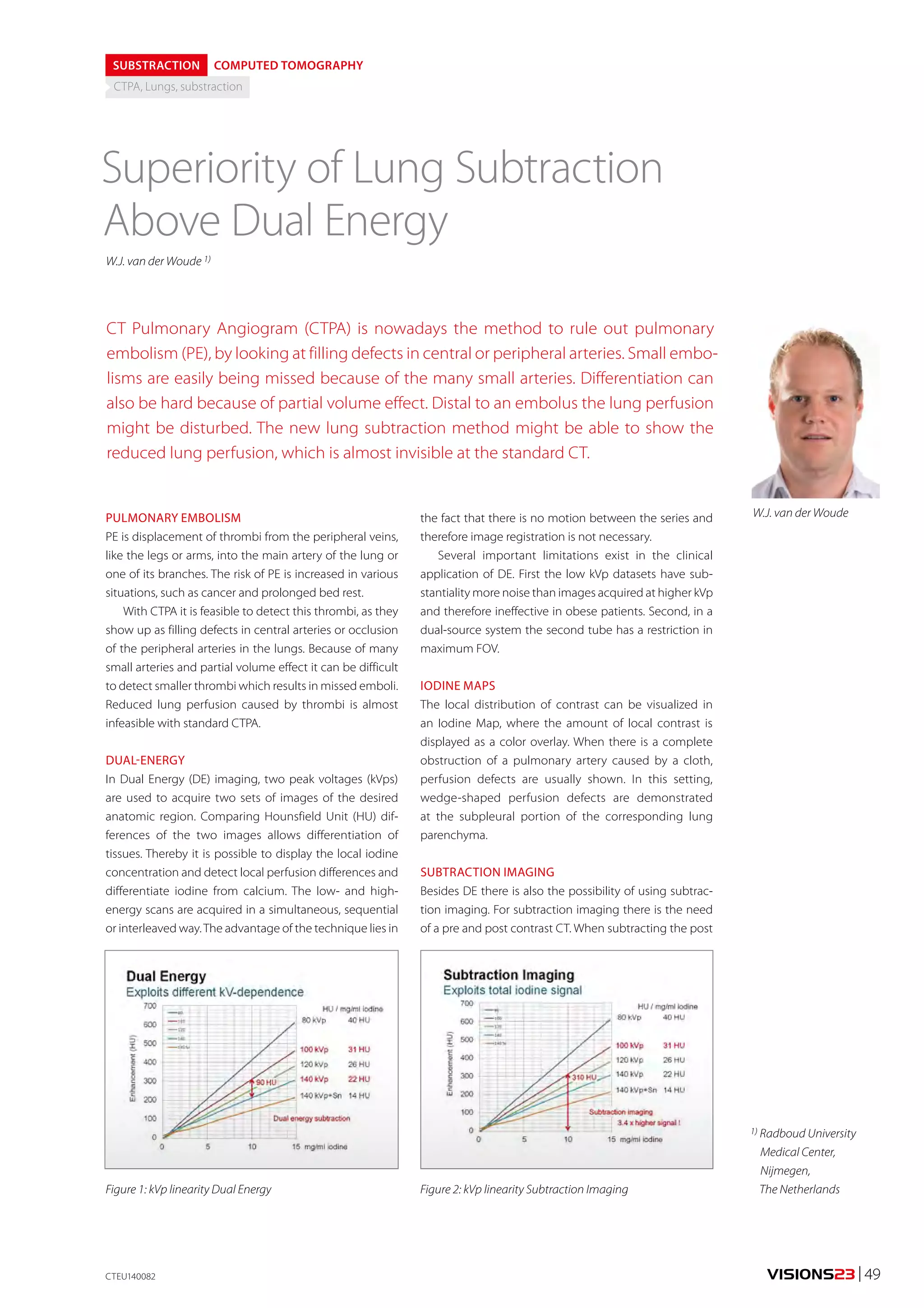 VISIONS23 | 49 
SUBSTRACTION COMPUTED TOMOGRAPHY 
CTPA, Lungs, substraction 
Superiority of Lung Subtraction 
Above Dual Energy 
W.J. van der Woude 1) 
CT Pulmonary Angiogram (CTPA) is nowadays the method to rule out pulmonary 
embolism (PE), by looking at filling defects in central or peripheral arteries. Small embo-lisms 
are easily being missed because of the many small arteries. Differentiation can 
also be hard because of partial volume effect. Distal to an embolus the lung perfusion 
might be disturbed. The new lung subtraction method might be able to show the 
reduced lung perfusion, which is almost invisible at the standard CT. 
PULMONARY EMBOLISM 
PE is displacement of thrombi from the peripheral veins, 
like the legs or arms, into the main artery of the lung or 
one of its branches. The risk of PE is increased in various 
situations, such as cancer and prolonged bed rest. 
With CTPA it is feasible to detect this thrombi, as they 
show up as filling defects in central arteries or occlusion 
of the peripheral arteries in the lungs. Because of many 
small arteries and partial volume effect it can be difficult 
to detect smaller thrombi which results in missed emboli. 
Reduced lung perfusion caused by thrombi is almost 
infeasible with standard CTPA. 
DUAL-ENERGY 
In Dual Energy (DE) imaging, two peak voltages (kVps) 
are used to acquire two sets of images of the desired 
anatomic region. Comparing Hounsfield Unit (HU) dif-ferences 
of the two images allows differentiation of 
tissues. Thereby it is possible to display the local iodine 
concentration and detect local perfusion differences and 
differentiate iodine from calcium. The low- and high-energy 
scans are acquired in a simultaneous, sequential 
or interleaved way. The advantage of the technique lies in 
W.J. van der Woude 
1) Radboud University 
Medical Center, 
Nijmegen, 
The Netherlands 
CTEU140082 
the fact that there is no motion between the series and 
therefore image registration is not necessary. 
Several important limitations exist in the clinical 
application of DE. First the low kVp datasets have sub-stantiality 
more noise than images acquired at higher kVp 
and therefore ineffective in obese patients. Second, in a 
dual-source system the second tube has a restriction in 
maximum FOV. 
IODINE MAPS 
The local distribution of contrast can be visualized in 
an Iodine Map, where the amount of local contrast is 
displayed as a color overlay. When there is a complete 
obstruction of a pulmonary artery caused by a cloth, 
perfusion defects are usually shown. In this setting, 
wedge-shaped perfusion defects are demonstrated 
at the subpleural portion of the corresponding lung 
parenchyma. 
SUBTRACTION IMAGING 
Besides DE there is also the possibility of using subtrac-tion 
imaging. For subtraction imaging there is the need 
of a pre and post contrast CT. When subtracting the post 
Figure 1: kVp linearity Dual Energy Figure 2: kVp linearity Subtraction Imaging 
 