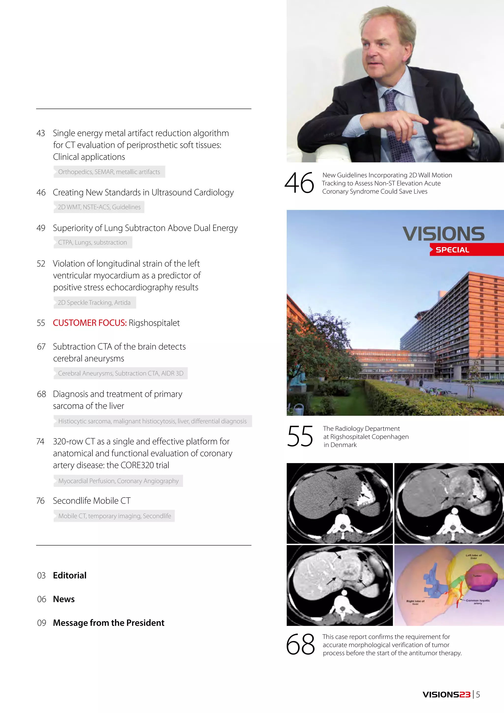 VISIONS23 | 5 
43 Single energy metal artifact reduction algorithm 
for CT evaluation of periprosthetic soft tissues: 
Clinical applications 
46 Creating New Standards in Ultrasound Cardiology 
49 Superiority of Lung Subtracton Above Dual Energy 
52 Violation of longitudinal strain of the left 
ventricular myocardium as a predictor of 
positive stress echocardiography results 
55 CUSTOMER FOCUS: Rigshospitalet 
67 Subtraction CTA of the brain detects 
cerebral aneurysms 
68 Diagnosis and treatment of primary 
sarcoma of the liver 
74 320-row CT as a single and effective platform for 
anatomical and functional evaluation of coronary 
artery disease: the CORE320 trial 
76 Secondlife Mobile CT 
46 
55 
68 
New Guidelines Incorporating 2D Wall Motion 
Tracking to Assess Non-ST Elevation Acute 
Coronary Syndrome Could Save Lives 
The Radiology Department 
at Rigshospitalet Copenhagen 
in Denmark 
This case report confirms the requirement for 
accurate morphological verification of tumor 
process before the start of the antitumor therapy. 
03 Editorial 
06 News 
09 Message from the President 
VISIONS 
SPECIAL 
Orthopedics, SEMAR, metallic artifacts 
2D WMT, NSTE-ACS, Guidelines 
CTPA, Lungs, substraction 
2D Speckle Tracking, Artida 
Cerebral Aneurysms, Subtraction CTA, AIDR 3D 
Histiocytic sarcoma, malignant histiocytosis, liver, differential diagnosis 
Myocardial Perfusion, Coronary Angiography 
Mobile CT, temporary imaging, Secondlife 
 