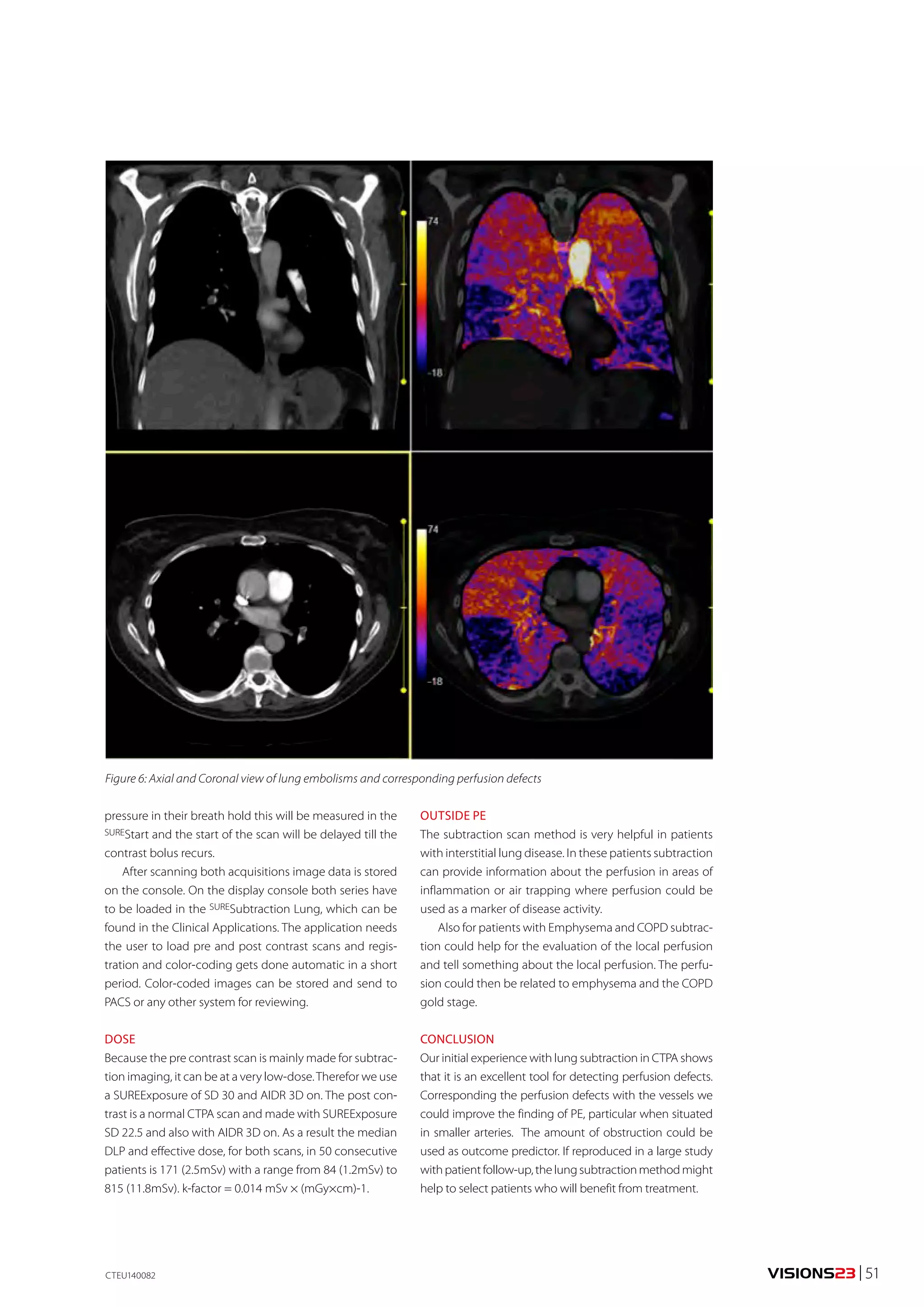 VISIONS23 | 51 
Figure 6: Axial and Coronal view of lung embolisms and corresponding perfusion defects 
pressure in their breath hold this will be measured in the 
SUREStart and the start of the scan will be delayed till the 
contrast bolus recurs. 
After scanning both acquisitions image data is stored 
on the console. On the display console both series have 
to be loaded in the SURESubtraction Lung, which can be 
found in the Clinical Applications. The application needs 
the user to load pre and post contrast scans and regis-tration 
and color-coding gets done automatic in a short 
period. Color-coded images can be stored and send to 
PACS or any other system for reviewing. 
DOSE 
Because the pre contrast scan is mainly made for subtrac-tion 
imaging, it can be at a very low-dose. Therefor we use 
a SUREExposure of SD 30 and AIDR 3D on. The post con-trast 
is a normal CTPA scan and made with SUREExposure 
SD 22.5 and also with AIDR 3D on. As a result the median 
DLP and effective dose, for both scans, in 50 consecutive 
patients is 171 (2.5mSv) with a range from 84 (1.2mSv) to 
815 (11.8mSv). k-factor = 0.014 mSv × (mGy×cm)-1. 
CTEU140082 
OUTSIDE PE 
The subtraction scan method is very helpful in patients 
with interstitial lung disease. In these patients subtraction 
can provide information about the perfusion in areas of 
inflammation or air trapping where perfusion could be 
used as a marker of disease activity. 
Also for patients with Emphysema and COPD subtrac-tion 
could help for the evaluation of the local perfusion 
and tell something about the local perfusion. The perfu-sion 
could then be related to emphysema and the COPD 
gold stage. 
CONCLUSION 
Our initial experience with lung subtraction in CTPA shows 
that it is an excellent tool for detecting perfusion defects. 
Corresponding the perfusion defects with the vessels we 
could improve the finding of PE, particular when situated 
in smaller arteries. The amount of obstruction could be 
used as outcome predictor. If reproduced in a large study 
with patient follow-up, the lung subtraction method might 
help to select patients who will benefit from treatment. 
 