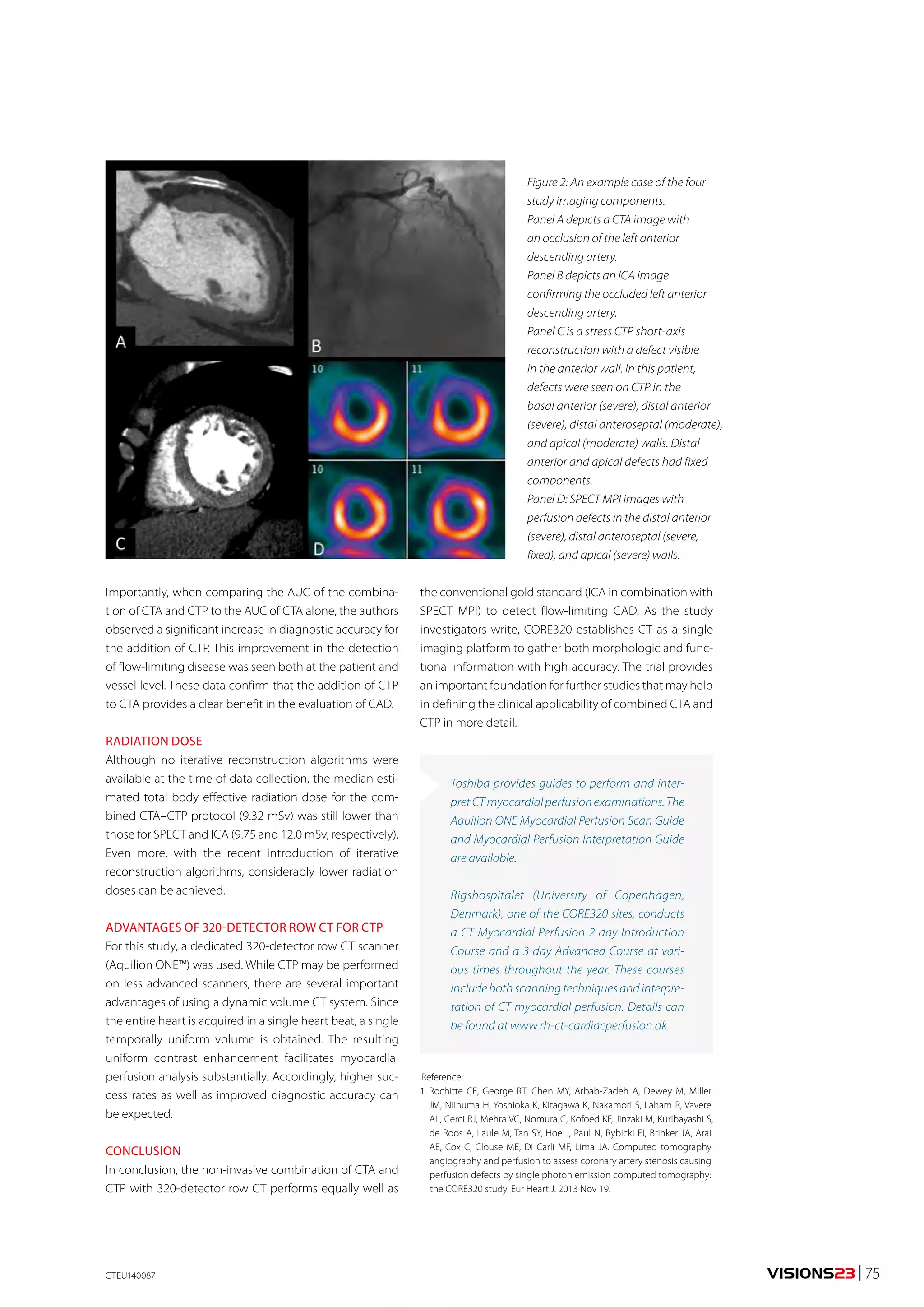 VISIONS23 | 75 
Figure 2: An example case of the four 
study imaging components. 
Panel A depicts a CTA image with 
an occlusion of the left anterior 
descending artery. 
Panel B depicts an ICA image 
confirming the occluded left anterior 
descending artery. 
Panel C is a stress CTP short-axis 
reconstruction with a defect visible 
in the anterior wall. In this patient, 
defects were seen on CTP in the 
basal anterior (severe), distal anterior 
(severe), distal anteroseptal (moderate), 
and apical (moderate) walls. Distal 
anterior and apical defects had fixed 
components. 
Panel D: SPECT MPI images with 
perfusion defects in the distal anterior 
(severe), distal anteroseptal (severe, 
fixed), and apical (severe) walls. 
Reference: 
1. Rochitte CE, George RT, Chen MY, Arbab-Zadeh A, Dewey M, Miller 
JM, Niinuma H, Yoshioka K, Kitagawa K, Nakamori S, Laham R, Vavere 
AL, Cerci RJ, Mehra VC, Nomura C, Kofoed KF, Jinzaki M, Kuribayashi S, 
de Roos A, Laule M, Tan SY, Hoe J, Paul N, Rybicki FJ, Brinker JA, Arai 
AE, Cox C, Clouse ME, Di Carli MF, Lima JA. Computed tomography 
angiography and perfusion to assess coronary artery stenosis causing 
perfusion defects by single photon emission computed tomography: 
the CORE320 study. Eur Heart J. 2013 Nov 19. 
Importantly, when comparing the AUC of the combina-tion 
of CTA and CTP to the AUC of CTA alone, the authors 
observed a significant increase in diagnostic accuracy for 
the addition of CTP. This improvement in the detection 
of flow-limiting disease was seen both at the patient and 
vessel level. These data confirm that the addition of CTP 
to CTA provides a clear benefit in the evaluation of CAD. 
RADIATION DOSE 
Although no iterative reconstruction algorithms were 
available at the time of data collection, the median esti-mated 
total body effective radiation dose for the com-bined 
CTA–CTP protocol (9.32 mSv) was still lower than 
those for SPECT and ICA (9.75 and 12.0 mSv, respectively). 
Even more, with the recent introduction of iterative 
reconstruction algorithms, considerably lower radiation 
doses can be achieved. 
ADVANTAGES OF 320-DETECTOR ROW CT FOR CTP 
For this study, a dedicated 320-detector row CT scanner 
(Aquilion ONE™) was used. While CTP may be performed 
on less advanced scanners, there are several important 
advantages of using a dynamic volume CT system. Since 
the entire heart is acquired in a single heart beat, a single 
temporally uniform volume is obtained. The resulting 
uniform contrast enhancement facilitates myocardial 
perfusion analysis substantially. Accordingly, higher suc-cess 
rates as well as improved diagnostic accuracy can 
be expected. 
CONCLUSION 
In conclusion, the non-invasive combination of CTA and 
CTP with 320-detector row CT performs equally well as 
the conventional gold standard (ICA in combination with 
SPECT MPI) to detect flow-limiting CAD. As the study 
investigators write, CORE320 establishes CT as a single 
imaging platform to gather both morphologic and func-tional 
information with high accuracy. The trial provides 
an important foundation for further studies that may help 
in defining the clinical applicability of combined CTA and 
CTP in more detail. 
Toshiba provides guides to perform and inter-pret 
CT myocardial perfusion examinations. The 
Aquilion ONE Myocardial Perfusion Scan Guide 
and Myocardial Perfusion Interpretation Guide 
are available. 
Rigshospitalet (University of Copenhagen, 
Denmark), one of the CORE320 sites, conducts 
a CT Myocardial Perfusion 2 day Introduction 
Course and a 3 day Advanced Course at vari-ous 
times throughout the year. These courses 
include both scanning techniques and interpre-tation 
of CT myocardial perfusion. Details can 
be found at www.rh-ct-cardiacperfusion.dk. 
CTEU140087 
 