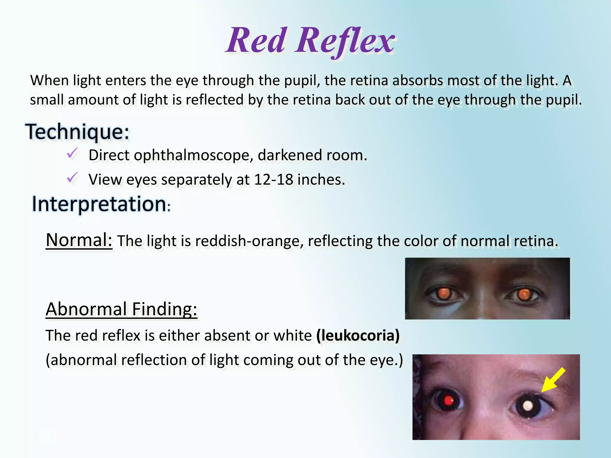 19
 Direct ophthalmoscope, darkened room.
 View eyes separately at 12-18 inches.
Red Reflex
Normal: The light is reddish-orange, reflecting the color of normal retina.
Interpretation:
Abnormal Finding:
The red reflex is either absent or white (leukocoria)
(abnormal reflection of light coming out of the eye.)
Technique:
When light enters the eye through the pupil, the retina absorbs most of the light. A
small amount of light is reflected by the retina back out of the eye through the pupil.
 