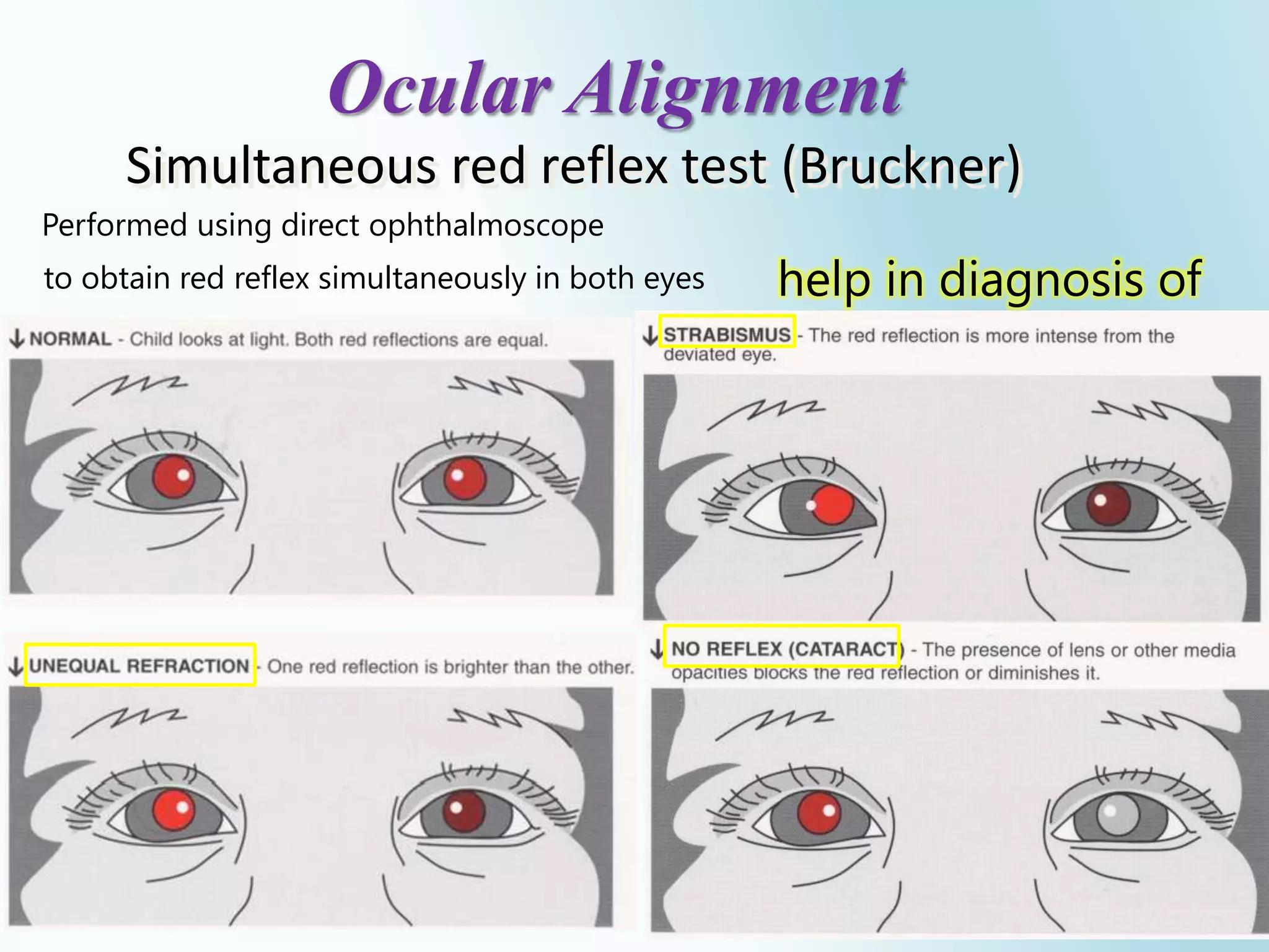 23
Ocular Alignment
Simultaneous red reflex test (Bruckner)
Performed using direct ophthalmoscope
to obtain red reflex simultaneously in both eyes help in diagnosis of
 