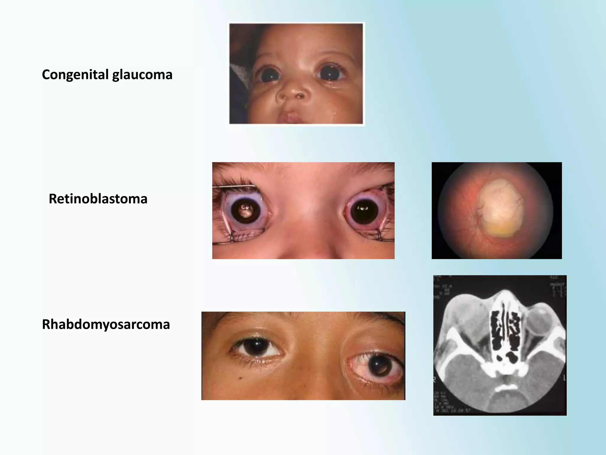 Retinoblastoma
Congenital glaucoma
Rhabdomyosarcoma
 