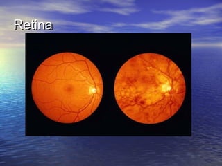 Retina
 
