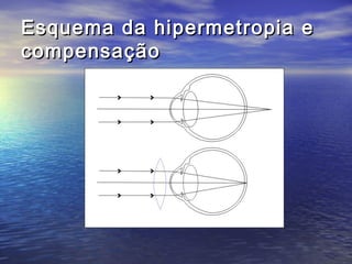Esquema da hipermetropia e
compensação
 