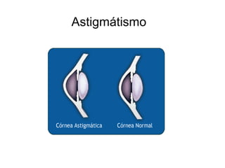 Astigmátismo
 
