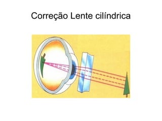 Correção Lente cilíndrica
 