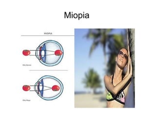 Miopia
 