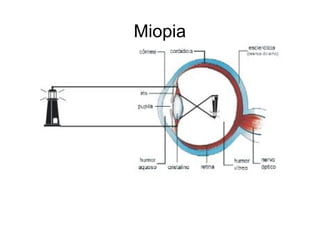 Miopia
 