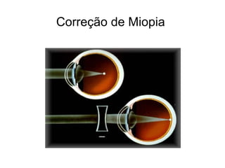 Correção de Miopia
 