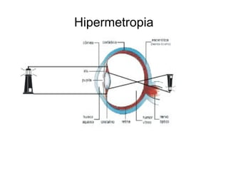 Hipermetropia
 