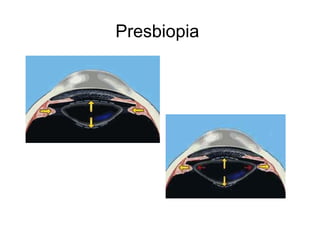 Presbiopia
 