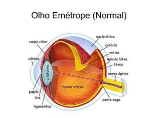Olho Emétrope (Normal)
 
