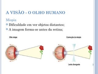 A VISÃO - O OLHO HUMANO 
Miopia 
 Dificuldade em ver objetos distantes; 
 A imagem forma-se antes da retina; 
 