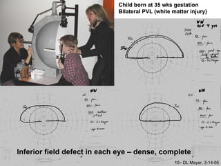 Visual field testing in pediatrics | PPT