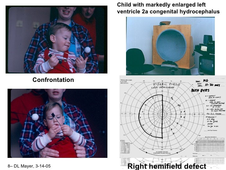 Visual field testing in pediatrics