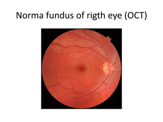 Normal fundus of rigth eye (OCT)
 