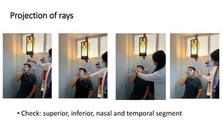 Projection of rays
• Check: superior, inferior, nasal and temporal segment
 
