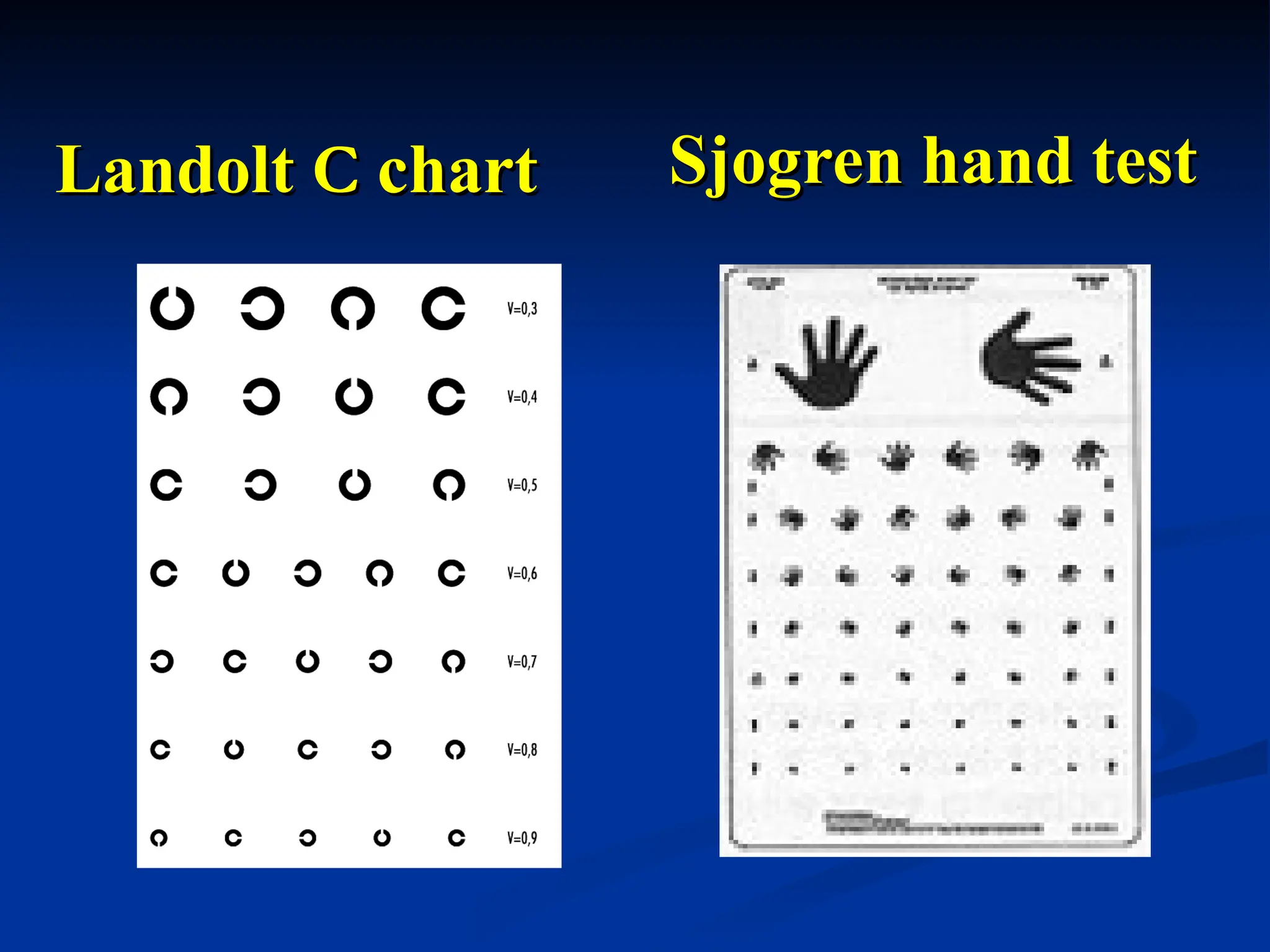 Landolt
Landolt C
C chart
chart Sjogren hand test
Sjogren hand test
 