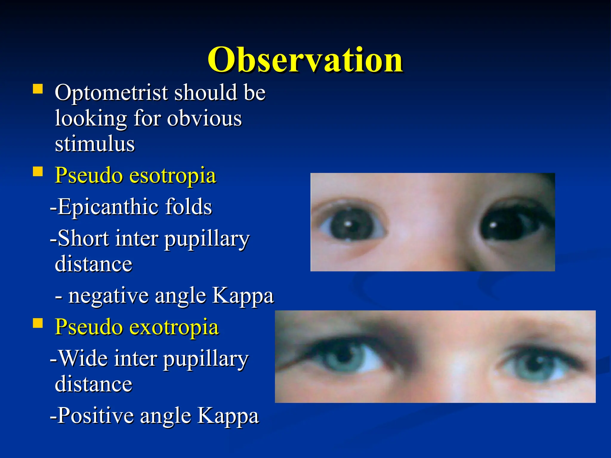 Observation
Observation
 Optometrist should be
Optometrist should be
looking for obvious
looking for obvious
stimulus
stimulus
 Pseudo esotropia
Pseudo esotropia
-Epicanthic folds
-Epicanthic folds
-Short inter pupillary
-Short inter pupillary
distance
distance
- negative angle Kappa
- negative angle Kappa
 Pseudo exotropia
Pseudo exotropia
-Wide inter pupillary
-Wide inter pupillary
distance
distance
-Positive angle Kappa
-Positive angle Kappa
 