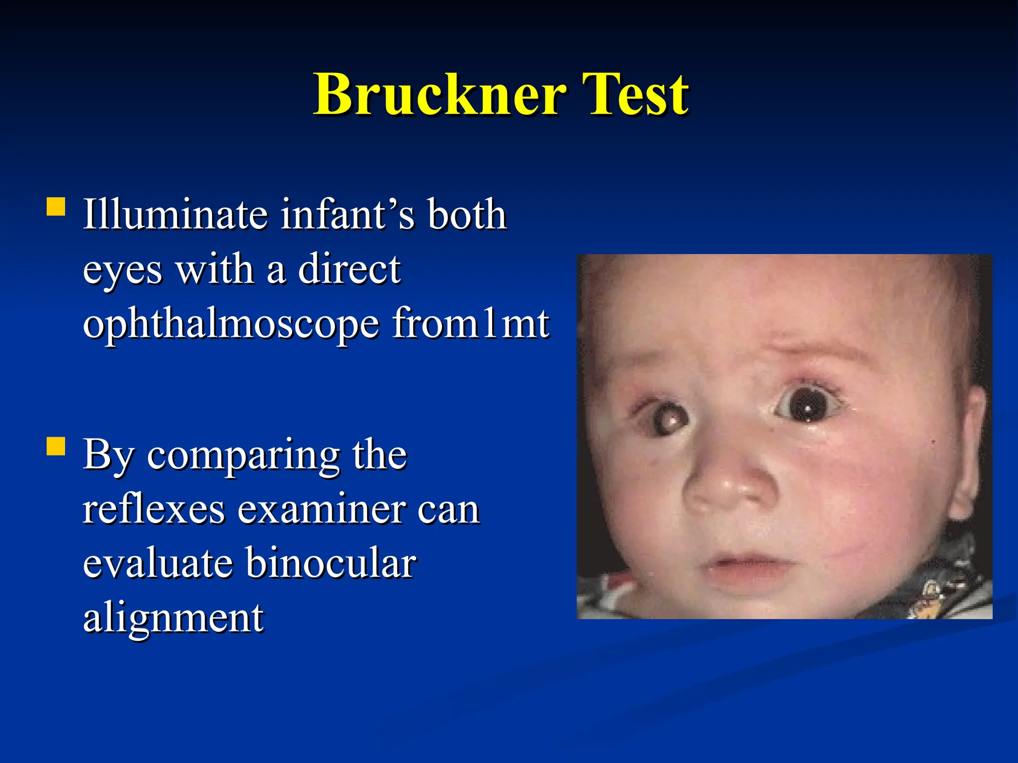 Bruckner Test
Bruckner Test
 Illuminate infant’s both
Illuminate infant’s both
eyes with a direct
eyes with a direct
ophthalmoscope from1mt
ophthalmoscope from1mt
 By comparing the
By comparing the
reflexes examiner can
reflexes examiner can
evaluate binocular
evaluate binocular
alignment
alignment
 