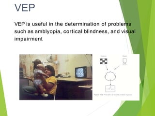 VEP
VEP is useful in the determination of problems
such as amblyopia, cortical blindness, and visual
impairment
 