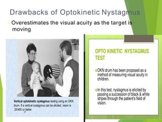 Drawbacks of Optokinetic Nystagmus
Overestimates the visual acuity as the target is
moving
 