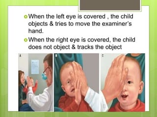 When the left eye is covered , the child
objects & tries to move the examiner’s
hand.
When the right eye is covered, the child
does not object & tracks the object
 