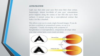 ASTIGMATISM
Light rays that enter your eyes first cross their clear cornea.
Surprisingly, almost two-thirds of your eyes’ concentration
power happens along the cornea or tear film (the eye’s front
surface). A normal cornea has a semi-spherical contour that
looks a lot like a baseball.
This allows your eye to create single-focused images. If you do
not have a uniform or symmetrical cornea, we say it is
‘astigmatic.’ Usually developing with symptoms of
farsightedness or nearsightedness, astigmatism develops when
your clear cornea lacks a non-round curvature
 