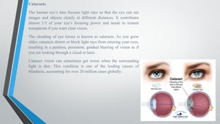 Cataracts
The human eye’s lens focuses light rays so that the eye can see
images and objects clearly at different distances. It contributes
almost 1/3 of your eye’s focusing power and needs to remain
transparent if you want clear vision.
The clouding of eye lenses is known as cataracts. As you grow
older, cataracts distort or block light rays from entering your eyes,
resulting in a painless, persistent, gradual blurring of vision as if
you are looking through a cloud or haze.
Cataract vision can sometimes get worse when the surrounding
light is dim. This condition is one of the leading causes of
blindness, accounting for over 20 million cases globally.
 