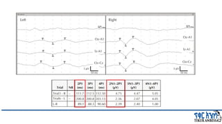 Comprehensive Overview of Visual Evoked Potentials in Neurology | PPTX