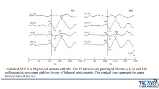 Comprehensive Overview of Visual Evoked Potentials in Neurology | PPTX