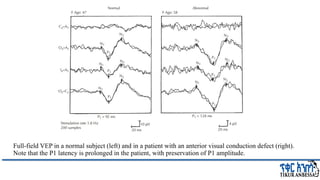 Comprehensive Overview of Visual Evoked Potentials in Neurology | PPTX
