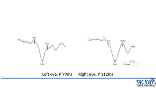 Comprehensive Overview of Visual Evoked Potentials in Neurology | PPTX
