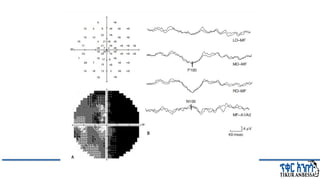 Comprehensive Overview of Visual Evoked Potentials in Neurology | PPTX