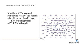 Comprehensive Overview of Visual Evoked Potentials in Neurology | PPTX