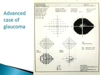 Advanced
case of
glaucoma
 