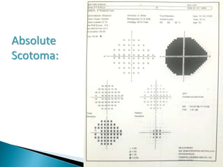 Absolute
Scotoma:
 